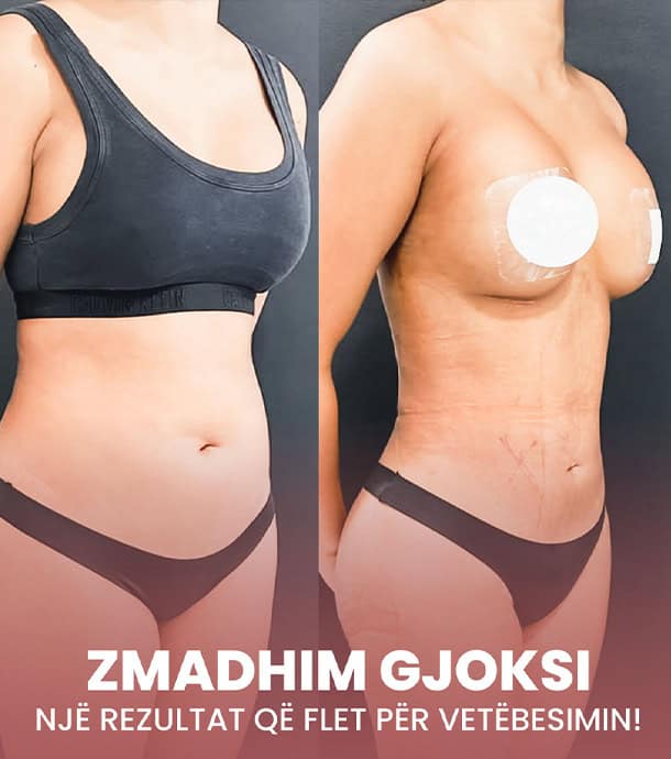 amazing before and after breast enlargement in Albania