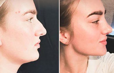 results before and after rhinoplasty in Albania