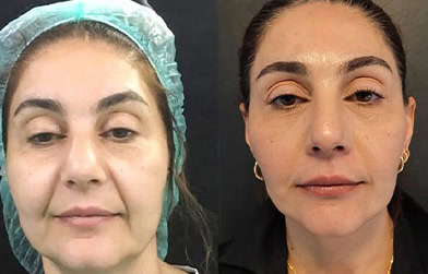 amazing results after face lift surgery in Albania